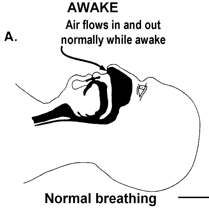 A Patient’s Guide to Understanding Sleep Apnea Sleep Consultants, Inc.