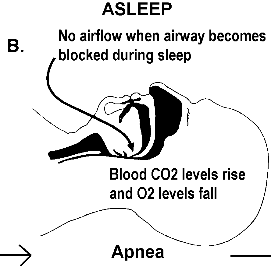 A Patient’s Guide to Understanding Sleep Apnea Sleep Consultants, Inc.