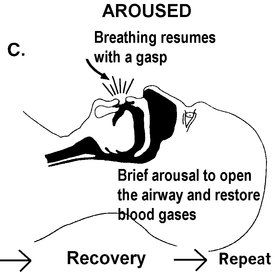 A Patient’s Guide to Understanding Sleep Apnea Sleep Consultants, Inc.